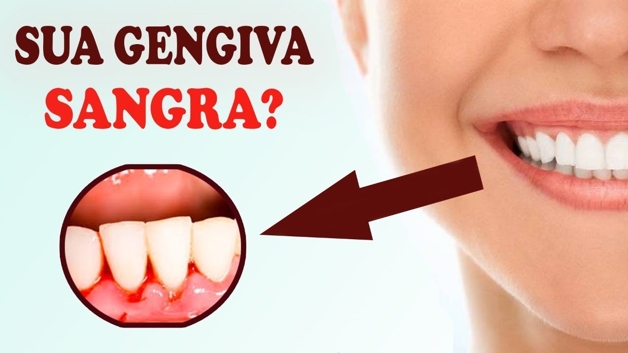Como curar GENGIVITE!