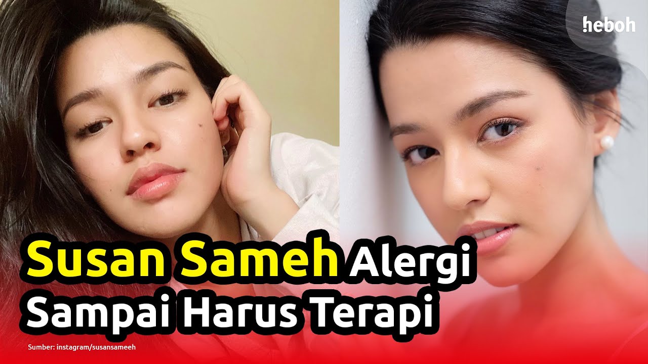 Sering Alergi Karena Berbagai Sebab, Susan Sameh Sampai Harus Lakukan Terapi
