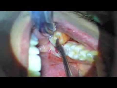 comment soulager extraction dent sagesse