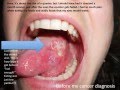 Tongue Cancer, Squamous Cell Carcinoma in ...