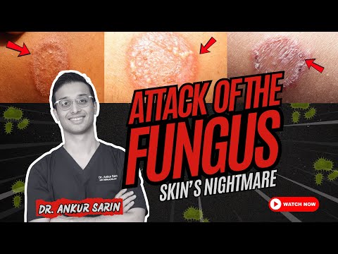 How To Treat Fungal Infection of Skin | Ringworm | Dr. Sarin