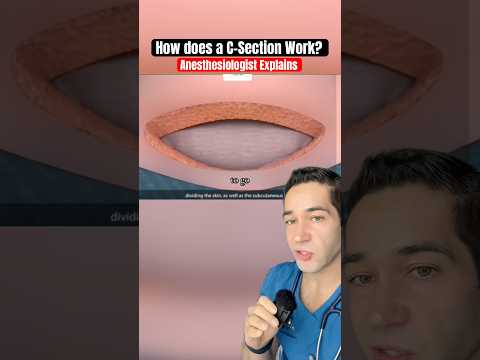 How do C-Sections REALLY work?