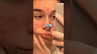 Why You Still Have Pimples And Acne The Real Reason | Glowup Tips |#shorts #shortvideo #acne