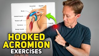 Exercises for Shoulder Pain and a Hooked Acromion