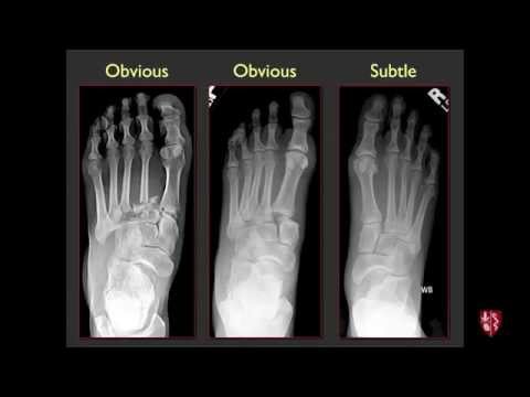 Tarsometatarsal Joints and Midfoot (Lisfranc) Sprains