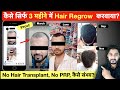 3 Months Hair Growth Result बिना Hair Transplant बिना PRP के