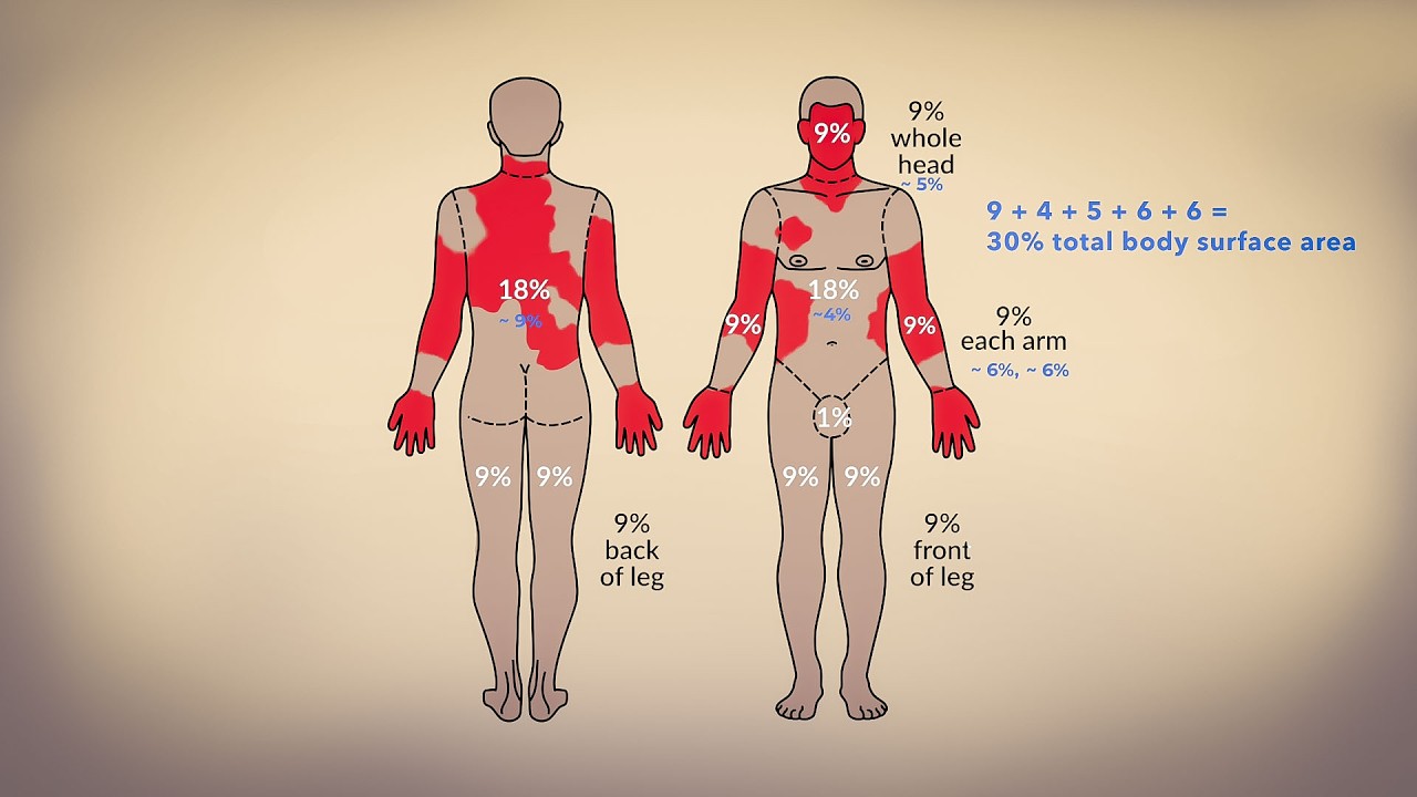 Giving Fluids for a New Burn - Emergency Care Series