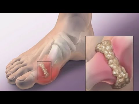 Tratament cu pantofi pentru ciuperca picioarelor și unghiilor