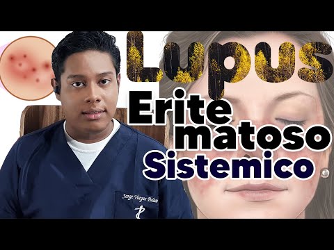 LUPUS ERITEMATOSO SISTÉMICO (LES) Síntomas, Fisiopatología y Tratamiento.