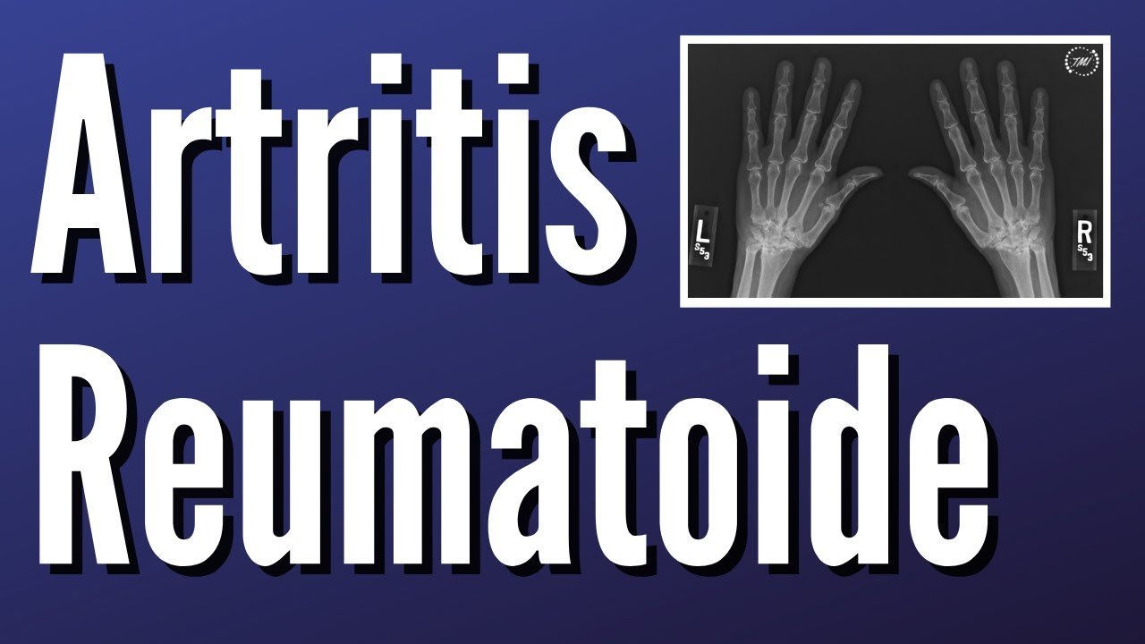 Artritis Reumatoide