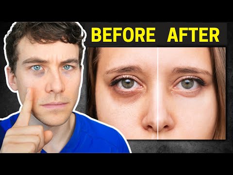 The Truth about Dark Circles: Causes and Proven Treatments