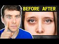 The Truth About Dark Circles Causes And Proven Treatments