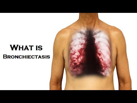 What is Bronchiectasis  | Dr Technology