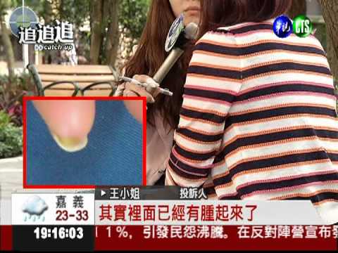 愛美做水晶指甲 指縫發炎化膿!