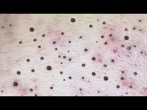 Blackhead removal Video #115 #Blackheads #blackheadsremoval #blackheadsextraction