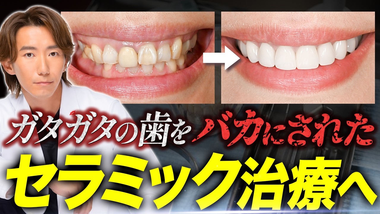 歯の黄ばみが気になって...40台女性が勇気を出してセラミック治療に密着解説
