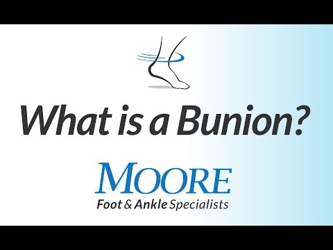 Cosmetic Toe Shortening Long Toe Surgery Video Without Metal Pins