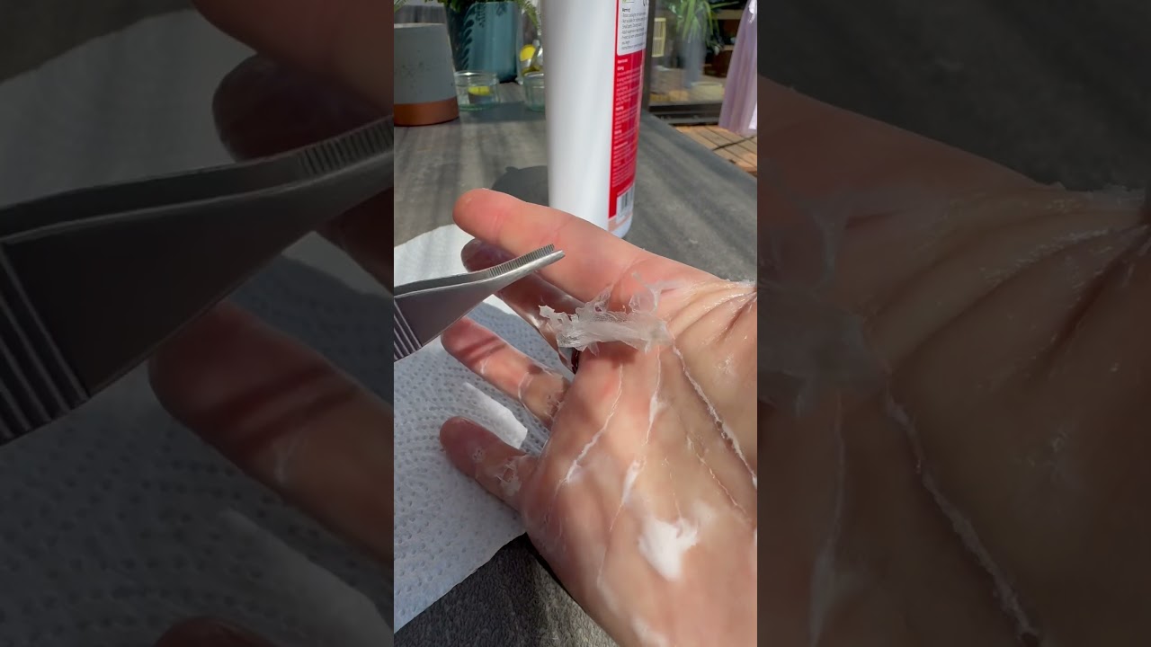 Tiny splinters everywhere! #fibreglass #extraction #splinters #splinterremoval