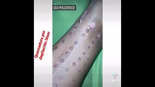 Quemaduras por depilación láser
