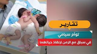توأم سيامي في سباق مع الزمن لإنقاذ حياتهما