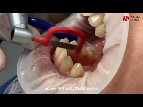DentaSonic IPR Sequence Steps - Interproximal Reduction Strips