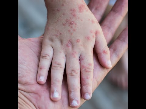 Viermi la copii comprimate pentru tratamentul simptomelor
