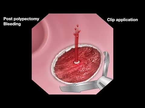LGI Bleeding 3e   Post EMR bleeding