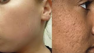 HOW TO GET RID OF LARGE PORES AND REDNESS OF FACE IN 3 DAYS |GET SMOOTH & TIGHTER SKIN