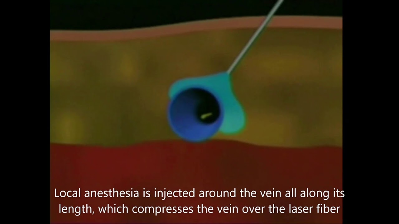 Laser Treatment of Varicose Veins — A Patient's Guide