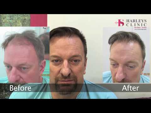 Harleys Hair Transplant Clinic in Mumbai Review – Medical tourism