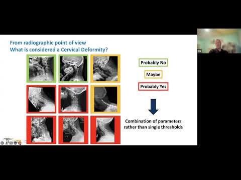 Cervical Deformity presented by Eric Klineberg, MD