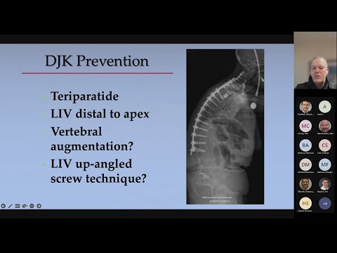 Prospective Multicenter Assessment of Complication Rates Adult Cervical Deformity E Klineberg, MD