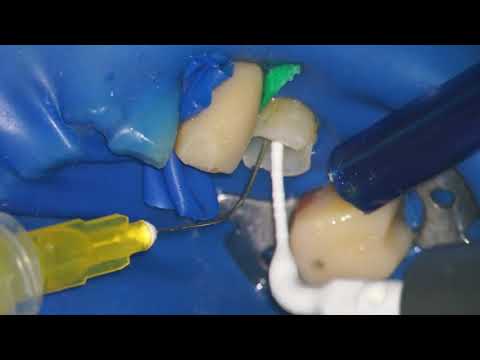 VDW Endodontic Irrigation EDDY Dental