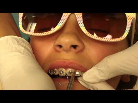 Placing the Niti Wire in the Deep Tunnel of the Tip-Edge Plus Bracket : Nirenblatt Orthodontics