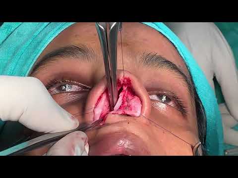 Deviated And Bent Septum Exposed During Septorhinoplasty