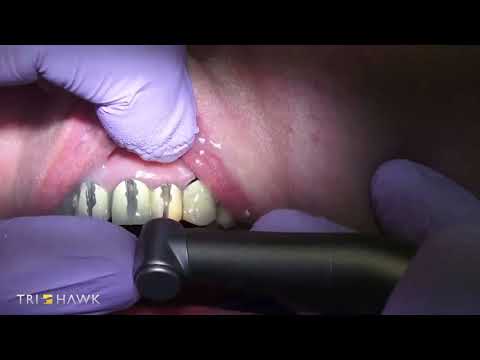 Бор для разрезания коронок , Бор для распила метала и керамики Talon 10 (Tri Hawk) 1 шт - фото 1 - id-p2511674785