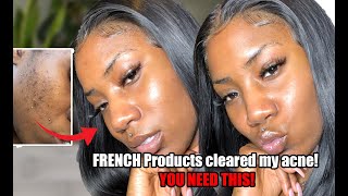 STOP USING THE ORDINARY SKIN PEEL AND USE THIS!! | CLEARED MY ACNE FAST | VanessaK7