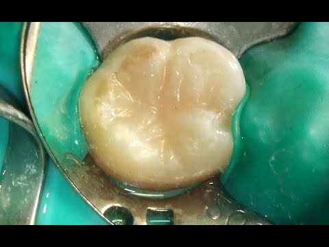 Zahnfüllungen aus Kunststoff: eine Alternative für Amalgam für (fast) alle Anwendungen.