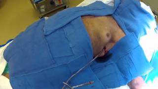 Chest Tube Insertion - Dennis Kim, MD