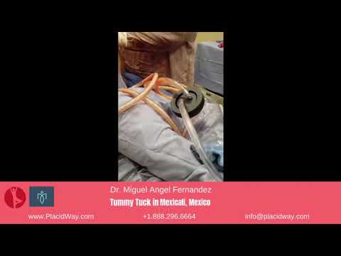 A Patient's Tale of Tummy Tuck by Dr. Miguel Angel Fernandez in Mexicali, Mexico