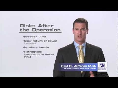 ALIF - Anterior Lumbar Interbody Fusion