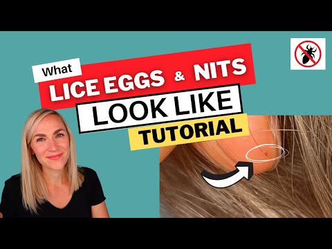 What Lice Eggs and Nits Look Like Video Tutorial