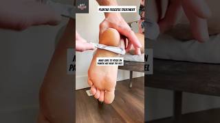 Try this!! Use this simple professional trick for plantar fasciitis 🤯 #pain #foot #fascia