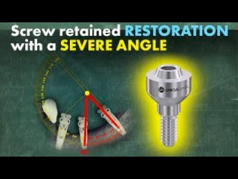 Getting the best out of a poorly placed dental implant using a screw retained restoration