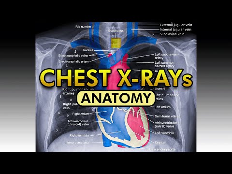 Chest X-Ray: Normal Radiological Anatomy Explained