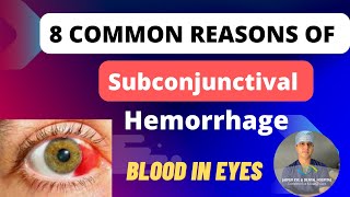 Blood in eyes : Subconjunctival Hemorrhage 8 Reasons and Treatment