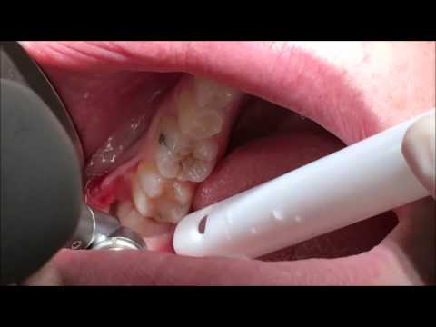 download lagu mp3 mp4 Surgical Extraction, download lagu Surgical Extraction gratis, unduh video klip Surgical Extraction