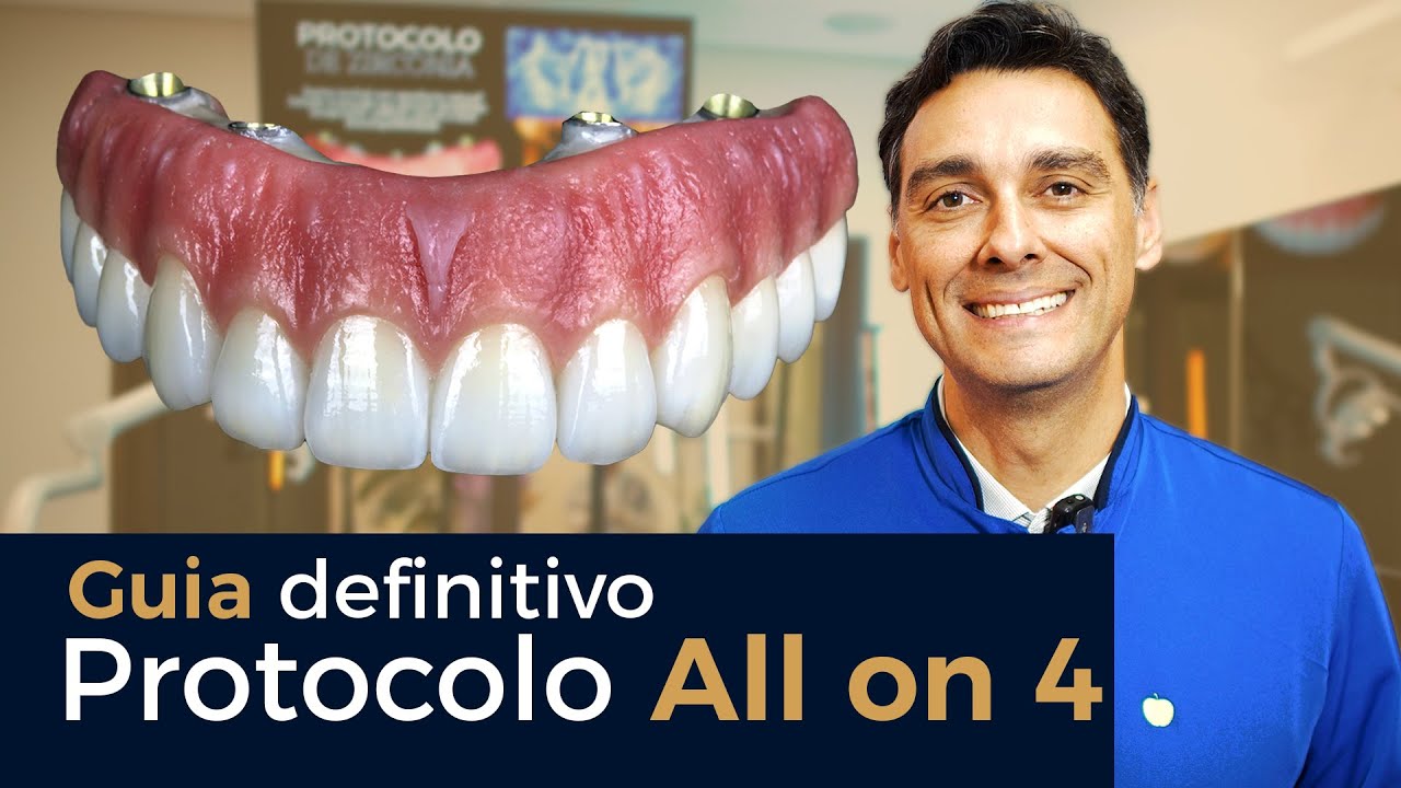 Guia Definitivo - Protocolo All on 4 - Implace Implantes