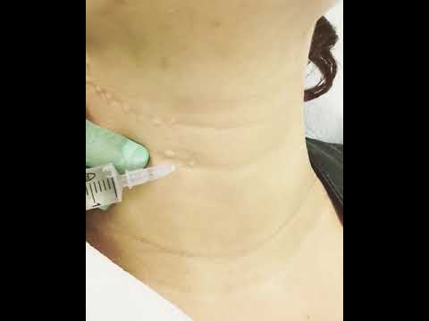Il laktofiltrum da pigmentary nota su una faccia Le procedure cosmetiche per candeggiare di pelle