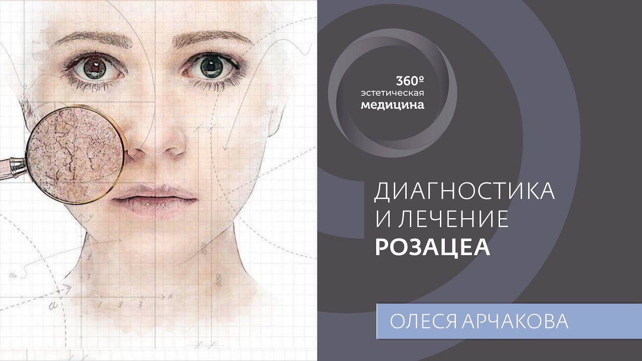 Диагностика и лечение розацеа